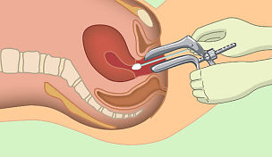 wow-l2-preventing-cervical-cancer-id10073-02.jpg